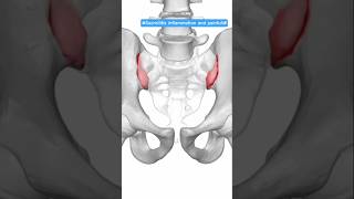 Sacroiliitis Pain Explained | SI Joint Inflammation Causes, Symptoms &amp; Treatment