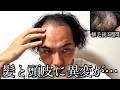 34歳ハゲ、植毛後に想像もしていなかった症状がでてきました。
