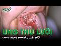 Loét lưỡi suốt 4 tháng, người đàn ông phát hiện ung thư ở tuổi 33 | SKĐS