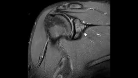 How does a post arthrogram MRI shoulder compare to a non contrast MRI for labral tear?