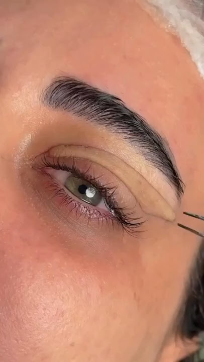 Blepharoplasty Without Fear: Safe, Painless, and Naturally Beautiful Results