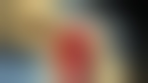 Cochlear Corp BAHA Attract Implant ear surgery in Ottawa