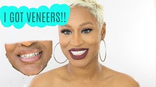 MY EXPERIENCE GETTING COMPOSITE VENEERS | WITH MEMPHIS DENTIST DR. PRICE