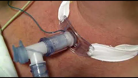 Come si chiude il buco della tracheotomia?