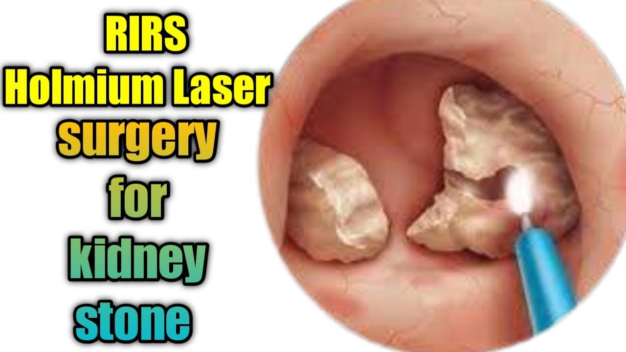 Surgery for kidney stone // RIRS HOLMIUM LASER SURGERY FOR KIDNEY STONE