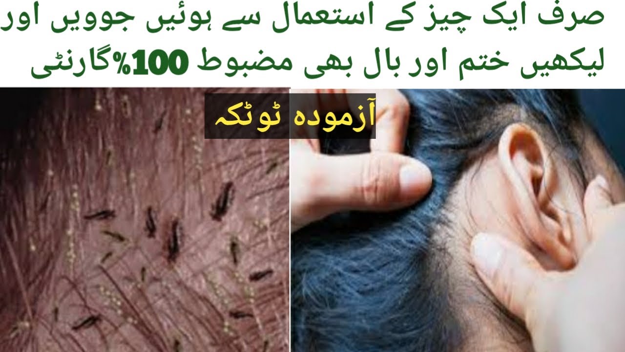 Head Lice Removal At Home Home Remedies for Lice Top Amazing Remedy