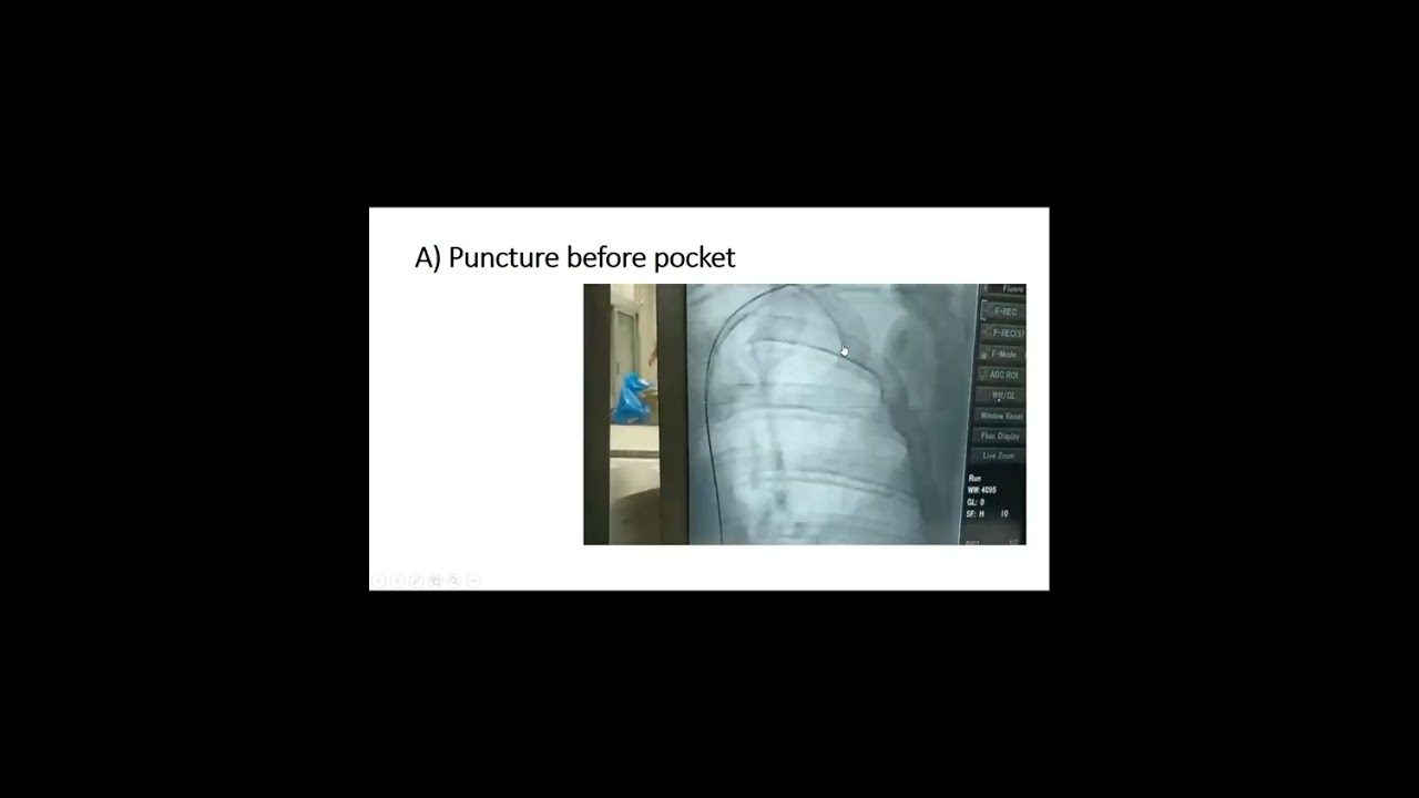 Tips and tricks for successful pacing in case of LPSVC - Moustafa Dawood