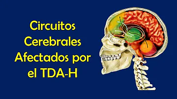 ¿Puede una resonancia magnética cerebral mostrar el TDAH?
