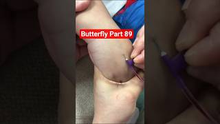 Butterfly IV Practice Part 89 🔥 | Medical Students Training Video #shorts #viral #butterflyshorts