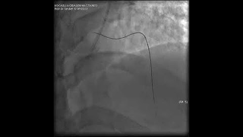 Microcatheter Tip Fracture During LAD CTO PCI: A Complication Video 4