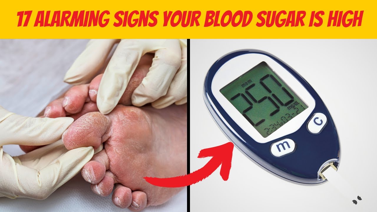 17 ALARMING Signs Your Blood Sugar Is HIGH YouTube