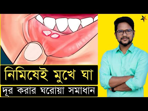 ভিডিও: আপনার মুখের কোণে ফাটল নিরাময়ের 3 উপায়