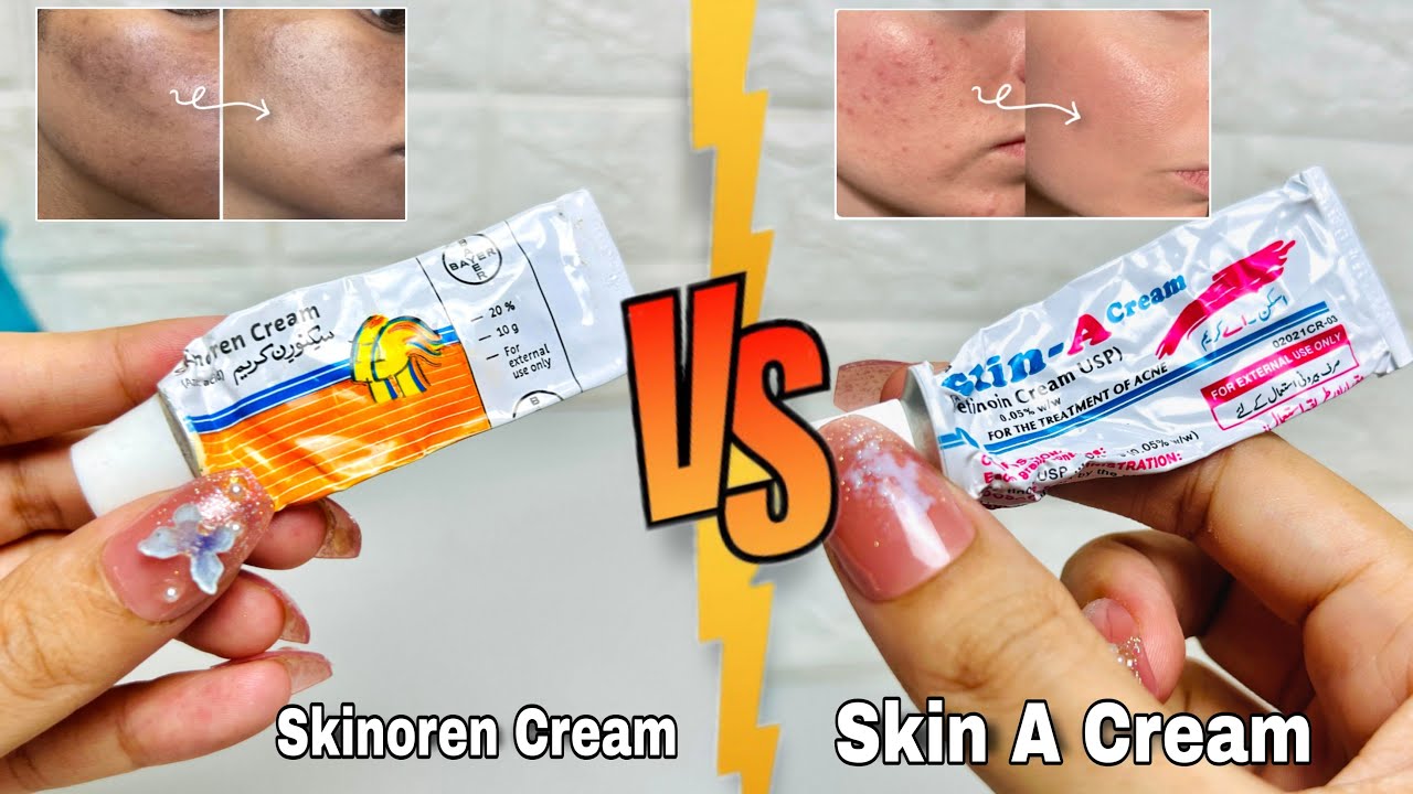 Skinoren vs Skin A Cream | Best Cream for Acne, Marks & Pigmentation? Honest Comparison 