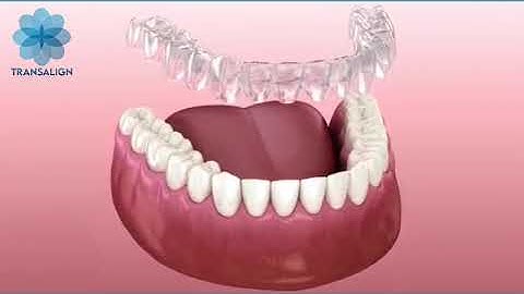 Niềng răng trong suốt Transalign