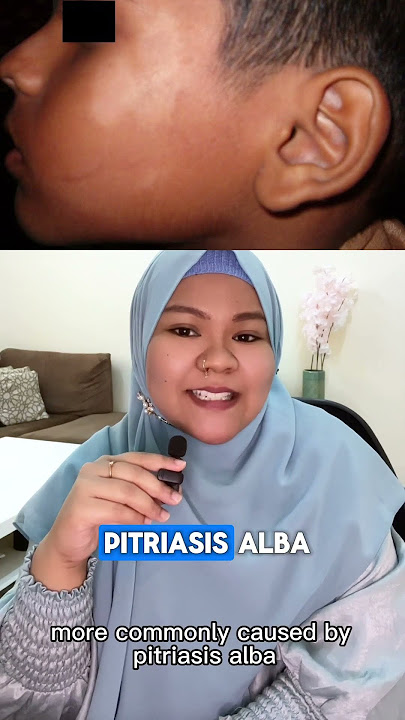 Bercak putih mirip panu di wajah anak part 1