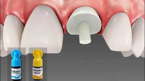 Core it Dual, Core Build up