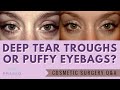 Puffy Eye Bags are Often Mistaken for Deep Tear Troughs - Treatment Differs on Severity