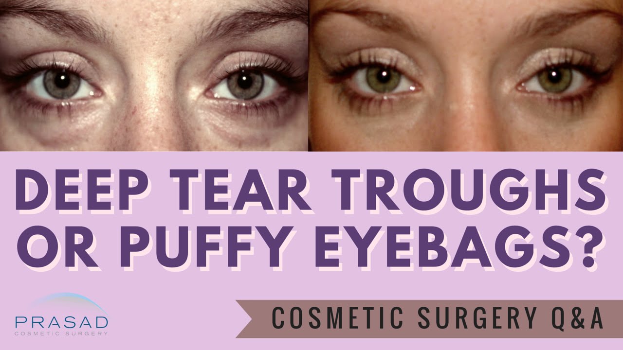 Under Eye Puffiness Got You Worried Here is The Solution  Be Beautiful  India