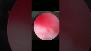 Abnormal uterine bleeding not responding to medical treatment. See and treat with hysteroscopy.