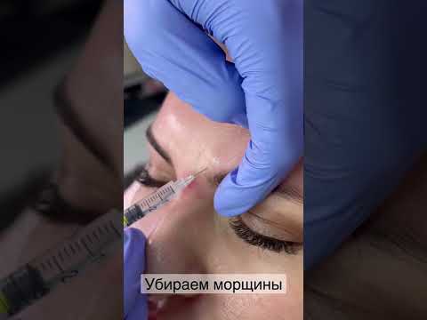 Инъекции ботокса