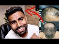 7 MONTH TURKEY HAIR TRANSPLANT UPDATE | PHASE 2