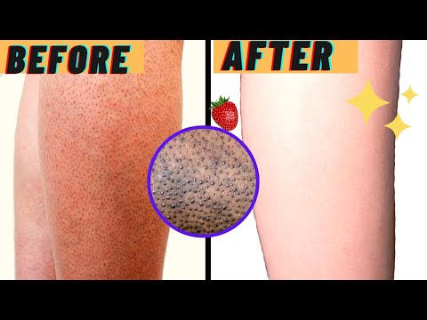 HOW TO GET RID OF STRAWBERRY LEGS IN ONE DAY! Get Rid Of Keratosis Pilaris And Dark Spots On Legs