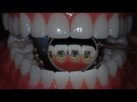 จัดฟันด้านใน ต้องดู! (braces time lapse)