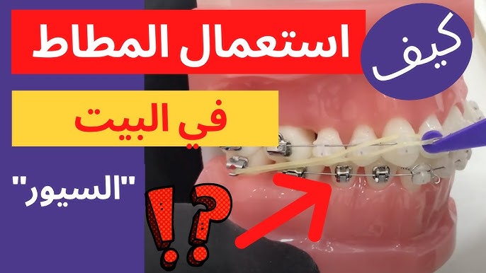 كيفية استخدام الأشرطة المطاطية المنزلية في تقويم الأسنان يوتيوب