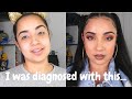 Going to Therapy- My diagnosis- CHIT CHAT GRWM| KissedByKen