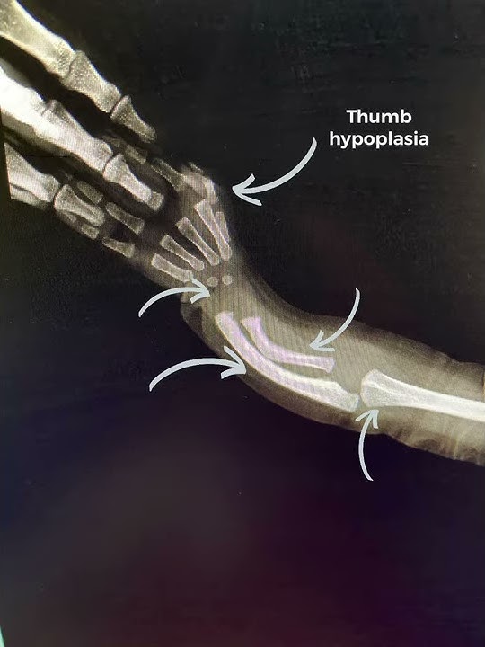 Radial dysplasia/ birth defect