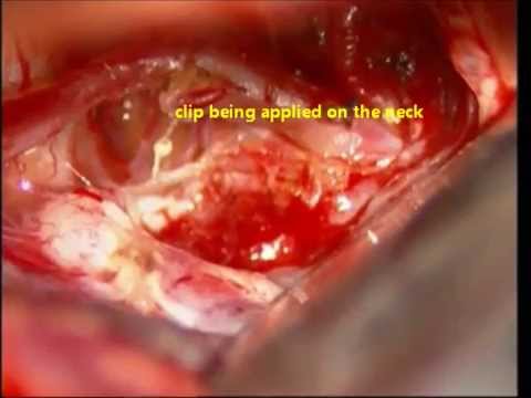 Brain Aneurysm-Anterior Communicating Artery-microsurgery-anatomy-dr Suresh DuganiHUBLI/INDIA