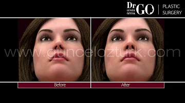 Comment se déroule une opération esthétique du nez ?