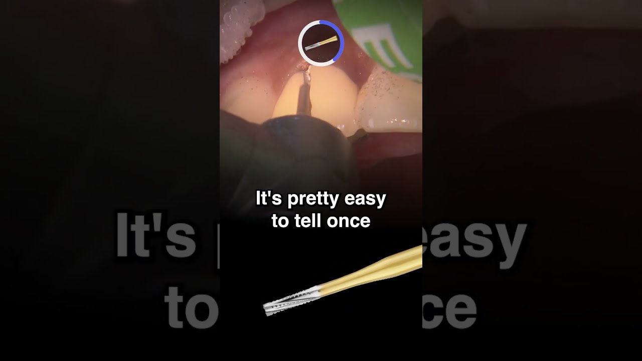 HOW TO Remove Old PFM Crown From An ANTERIOR Tooth Dental