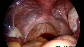 Female Laparoscopy \& Infertility by Fertility Doctor Raewyn Teirney