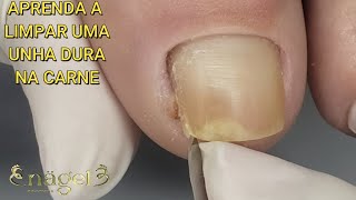 VOCÊS NÃO VÃO ACREDITAR NO QUE O FUNGO FEZ NESSA UNHA LINDA | Granuloma de grau I #satisfying #viral