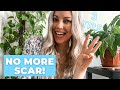 HOW TO FADE SURGERY SCARS | Thyroidectomy | Scar Care