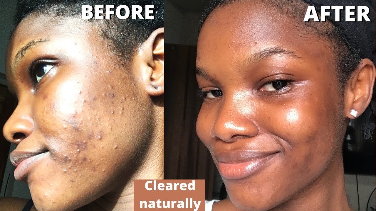 Must watch! HOW I CLEARED MY SKIN IN 4 WEEKS NATURALLY *no medications ...