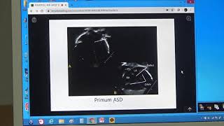 June 10, 2020 Yeongim Elementary School Web Symposium - Pediatric Cardiac Ultrasound (Dr. No Eun-...