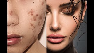 Amarose Skin Tag Remover Exposed Shark Tank Reviews With Super Luxe Skin Tag Remover