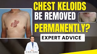 How to Get Rid of Keloids on the Chest Permanently |  Best Keloid Removal Treatment Options