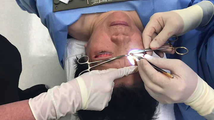 Upper Blepharoplasty & Brow Lift Procedure