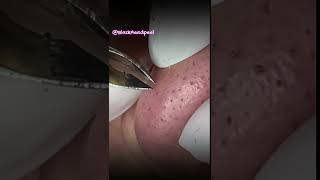 Relax Blackhead Removal 023  shorts   blackhead   acne  pimplesremoval  satisfying