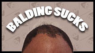 Balding Sucks 🥸 Enough Is Enough ❗️ Going Bald All Over Again 👩🏽‍🦲 | Grooming.@NeverDenyMe.com 💈