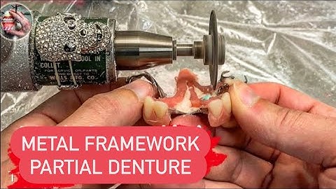 Making cast metal partial denture (all the steps to insert) تعويض جزئي على معدن ڤيتاليوم #WAXBAE