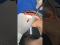 How to fix brace #dentist #brace #teeth