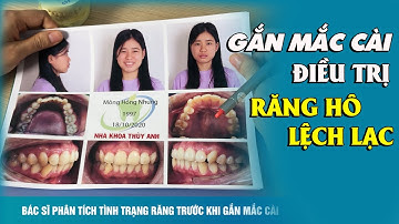 Gắn mắc cài niềng răng điều trị răng hô, răng khấp khểnh nặng