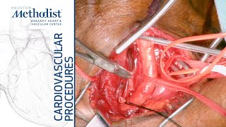 Carotid-Carotid-Subclavian Bypass with Vertebral Artery Transposition (Lumsden, MD, Andraos, MD)