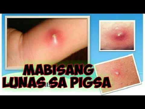 PIGSA GAMOT: Home remedies for boil anywhere in your body. How to treat