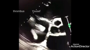Rt atrial thrombus echocardiography video