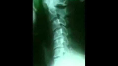 Video of degenerating cervical spine
